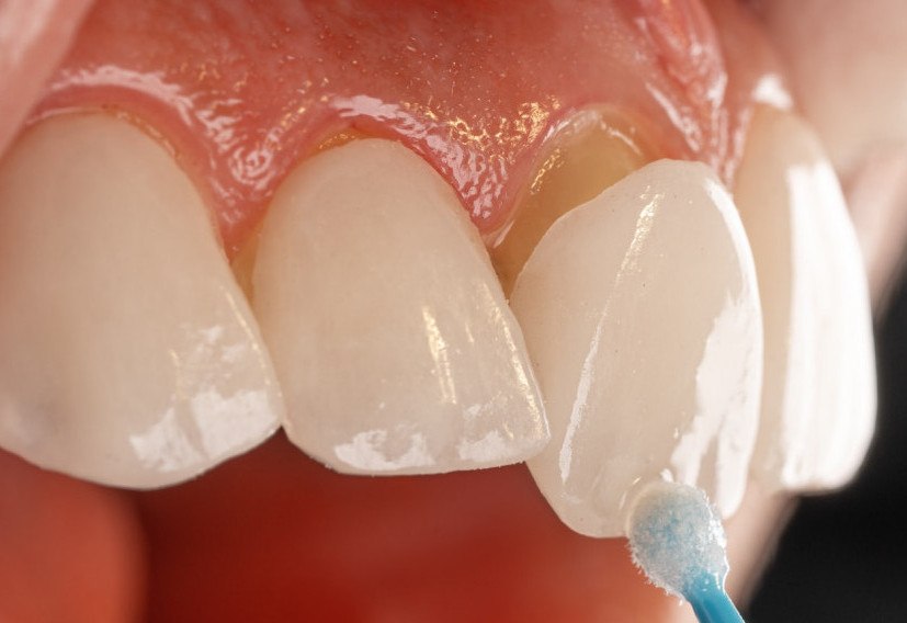 Low-Cost Dental Veneers