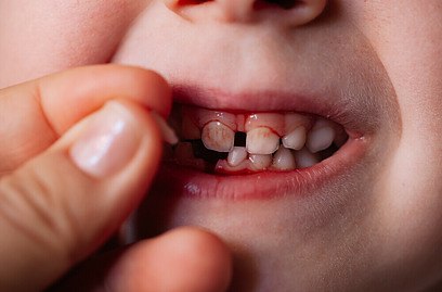 Dental Emergency